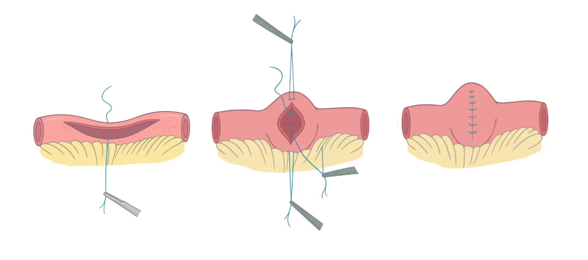 Νόσος Crohn