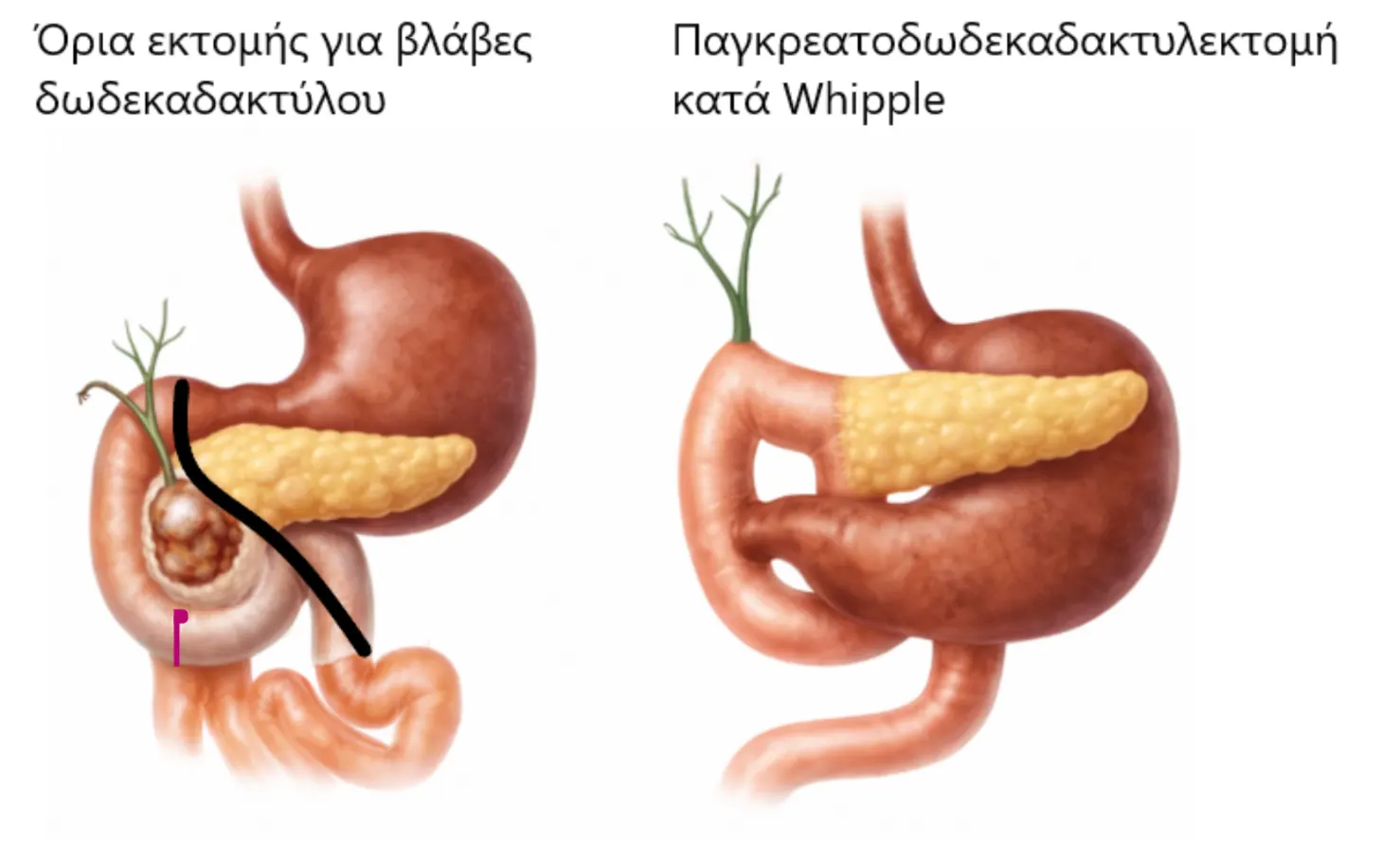 Καρκίνος Δωδεκαδακτύλου